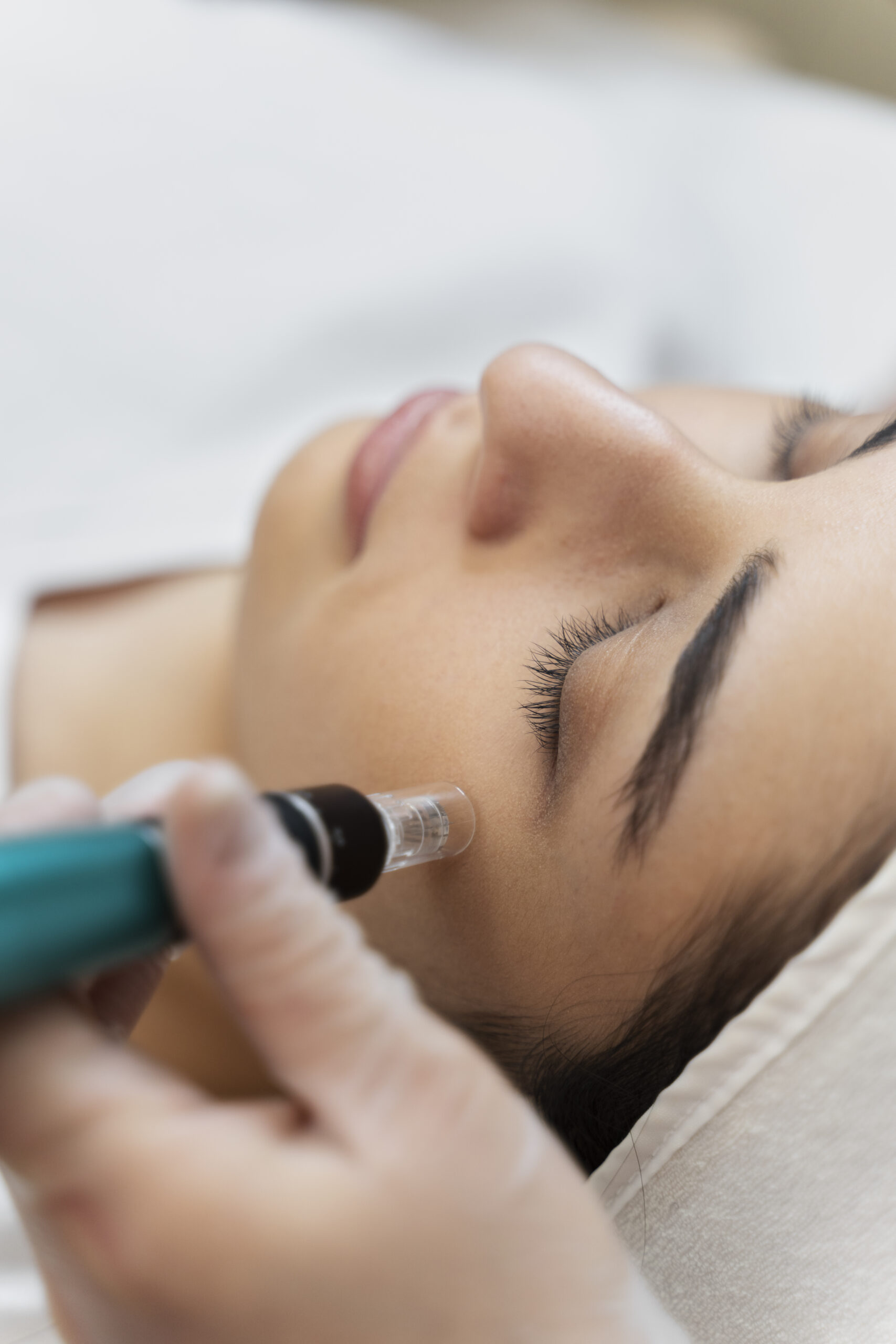 Cryopen Laser Treatments in Essex